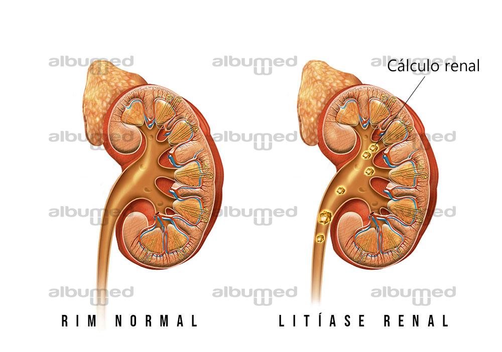 Litíase renal - AlbumMed
